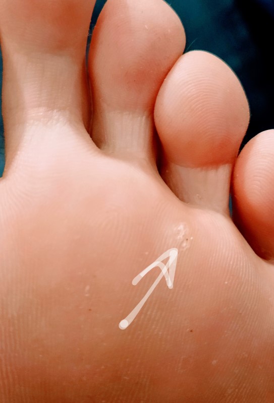 Traitement de la verrue plantaire par un podiatre