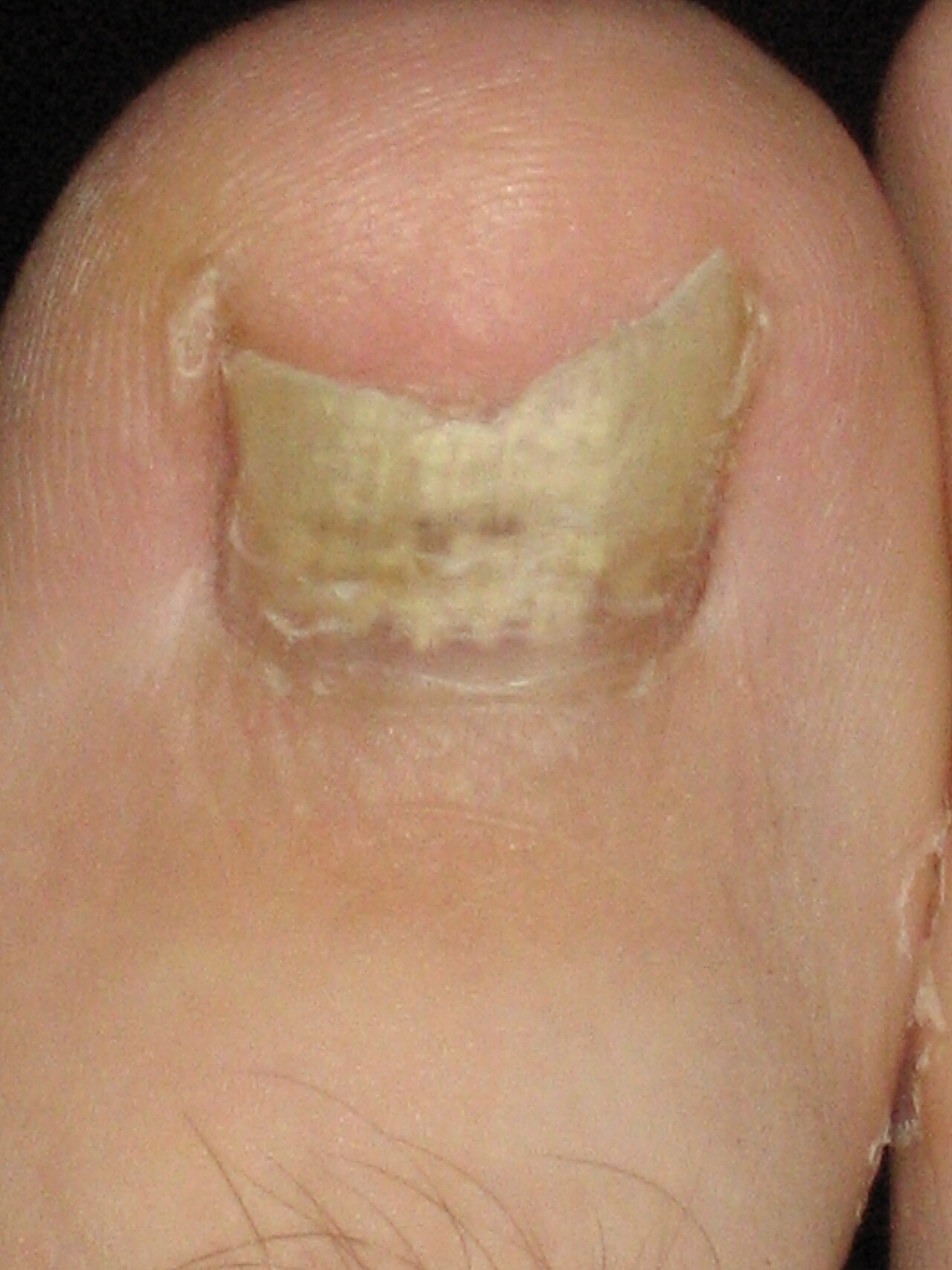 Mycose des ongles traitée par un podiatre