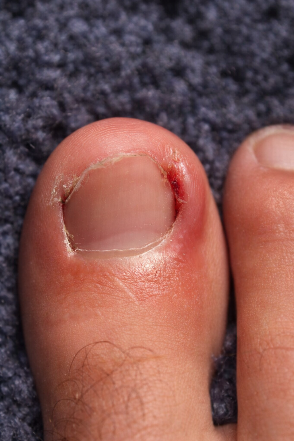 Ongle incarné avec rougeur latérale
