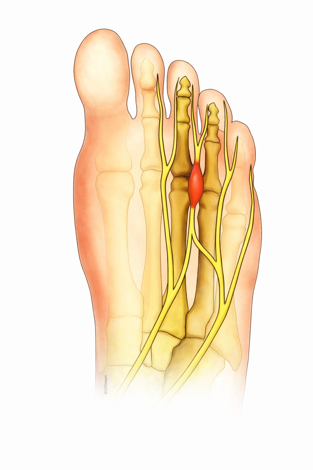 Morton's neuroma - foot pain